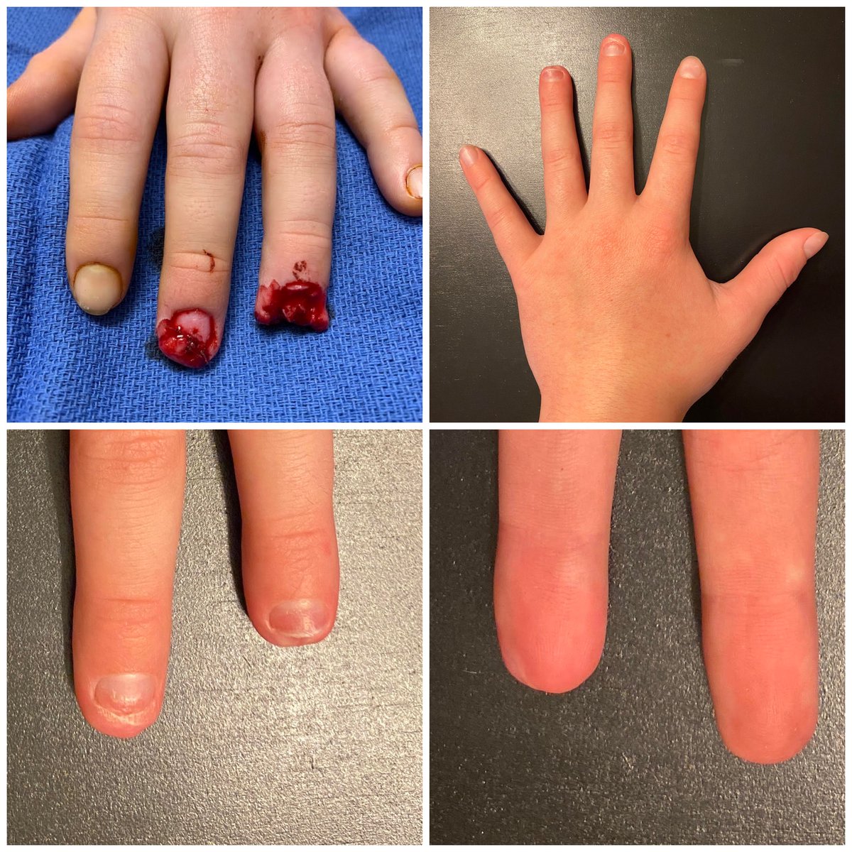 Wisdom Wednesday— sometimes the wisest decision we can make is to step back and do nothing.  Just over 3 months of non-operative treatment, with no impact on school attendance!