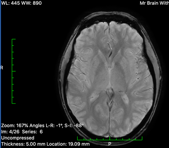 15/ My daily crippling headaches concerned doctors that the cancer had spread to my brain. The 1st MRI only worried them more, but after the 2nd they thankfully concluded it hadn’t. We now think they were caused by exhaustion: Not ideal timing for the CEO of a pivoting company.