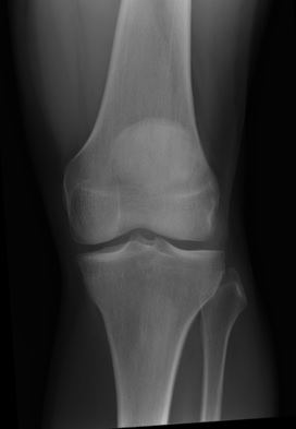 gaes,mngkin seumur hidup kalian ga akan kena sakit jantung, stroke, diabetes, gagal ginjal, usus buntu, bahkan mungkin kalian ga kena covid ..tapi ada suatu penyakit yg kalian nantinya pasti akan kena, yaitu OSTEOARTHRITIS, apa itu?bagaimana menangani nya?- A THREAD -