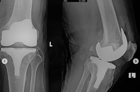 pada kasus yang berat,obat&semua mcm cara ud ga bisa lagi utk mengurangi sakit pasien,ngapa2in sakit, kasusnya uda parah, pada kasus yg sudah seperti ini, pilihan yg paling tepat adalah operasi, operasinya adalah operasi TKR (total knee replacement ) ,atau penggantian sendi lutut