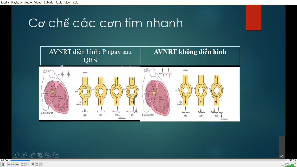 AnhNguyenMrMax1's tweet photo. The 5th #EPFoundation was successfully conducted on Fri 9th Oct - Atypical AVNRT. Thanks to Dr Nhu Hung and Dr Pham Tung from Hanoi Heart for sharing the precious knowledge in #EP
Next Fri will be a topic of VT.
#abbott #abbottproud #abbottep
Thank @hikingsley87 for hosting https://t.co/QoEYmZ4soS