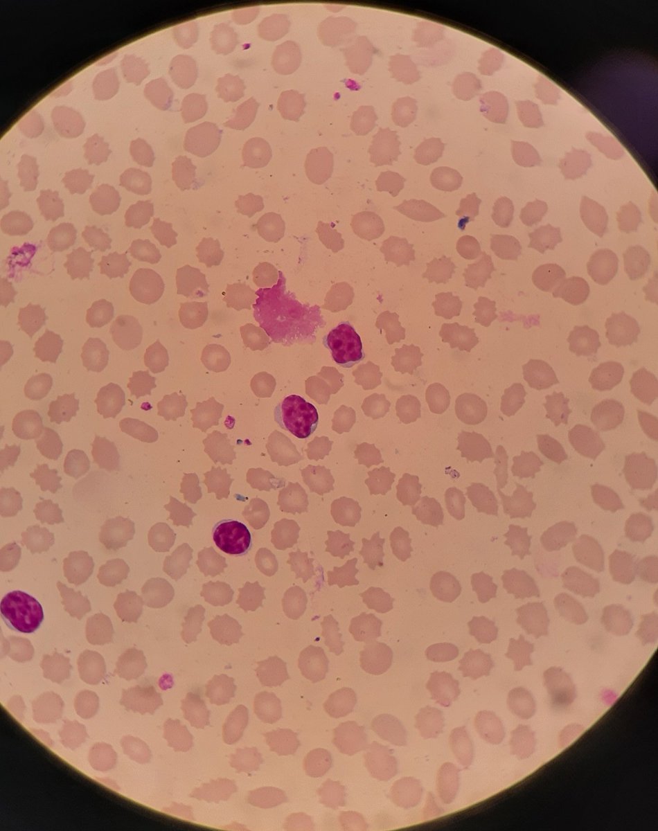 Soccer ball appearance of lymphocytes in CLL, suggestive of B cells.
#hemepath #PathTwitter