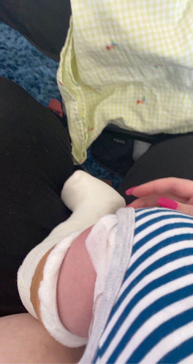 BellaJustin12's tweet photo. So painful seeing my newborn son with a cast on his leg breaks my heart https://t.co/7d5NYs66C8