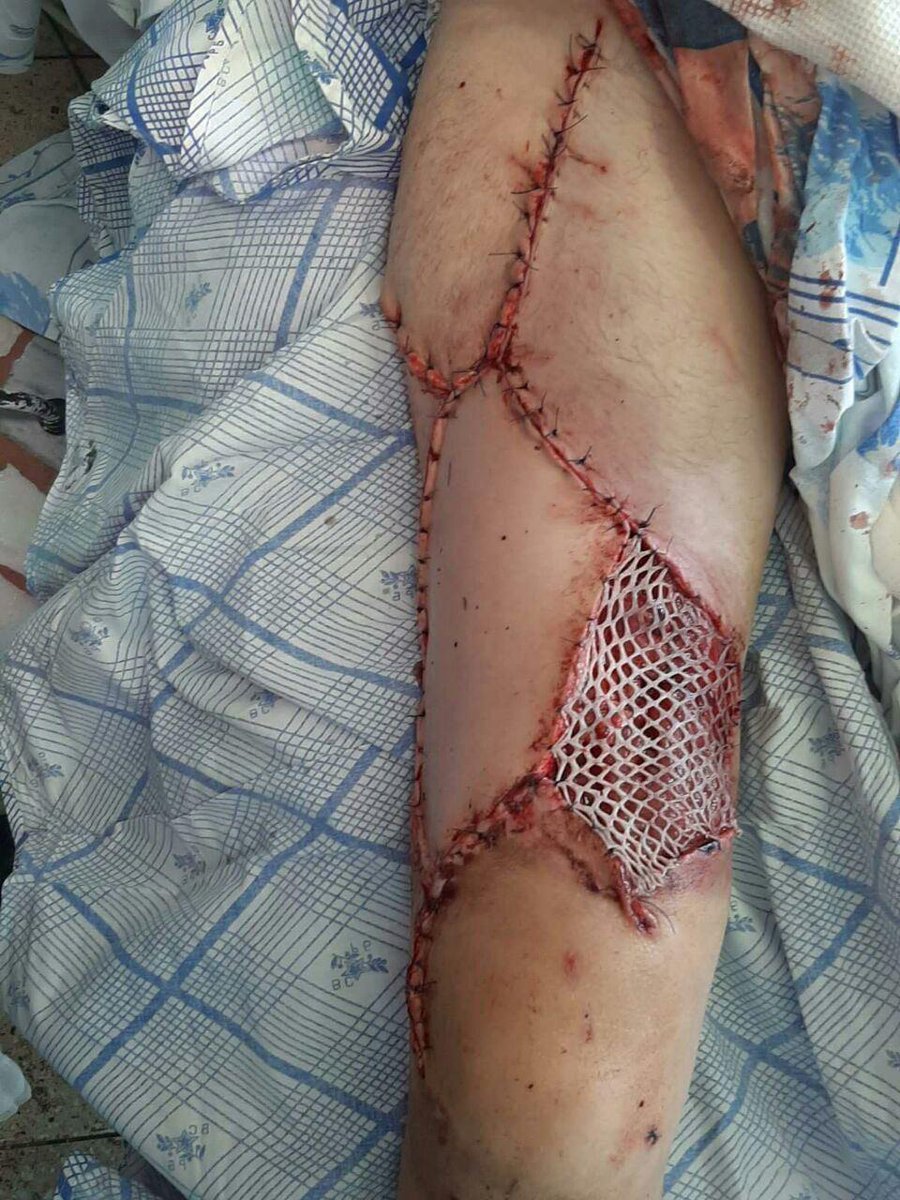 #Belarus Open wounds,avulsion injuries,amputated fingers and feet as the result of bullets and stun grenades deployed by riot police.These are the least brutal pictures Ican publish.People have their lungs shot.Only now we receive information from those badly injured. It's awful
