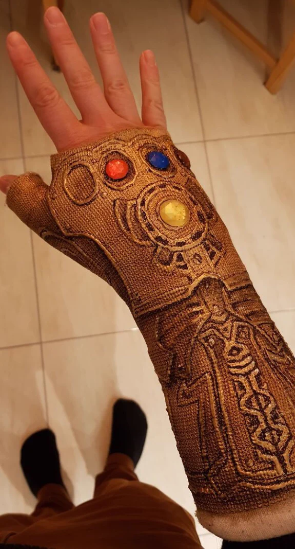 骨折したけどこの笑顔。付けたら骨折なんか一瞬で治りそうなギプス。