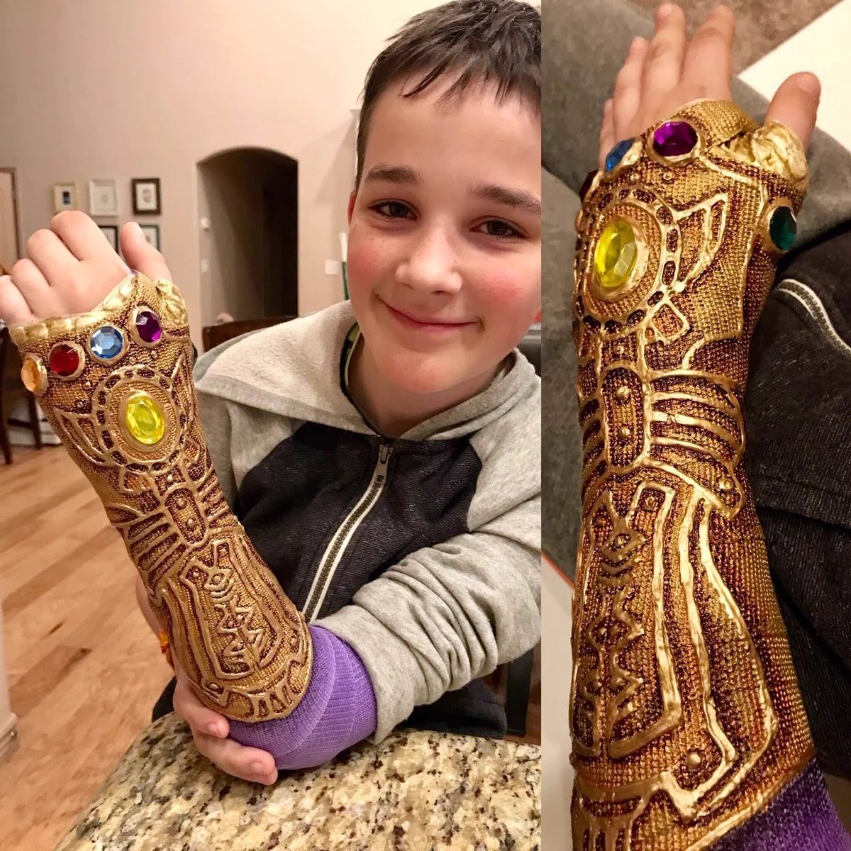 骨折したけどこの笑顔。付けたら骨折なんか一瞬で治りそうなギプス。