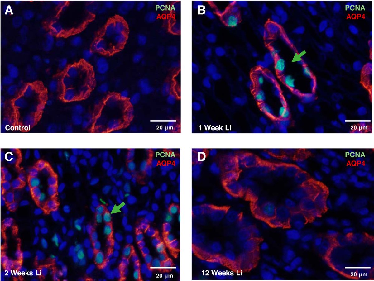 AJPRenal's tweet photo. #ImagesOfTheWeek: Inner medullary collecting duct (IMCD) principal cells label positively for proliferating cell nuclear antigen (PCNA) during early #lithium treatment.
Read about it here: https://t.co/XaiqVStaZN
#AJPRenal #Acid-BaseHomeostasis #Pendrin https://t.co/4GfuUti4qW