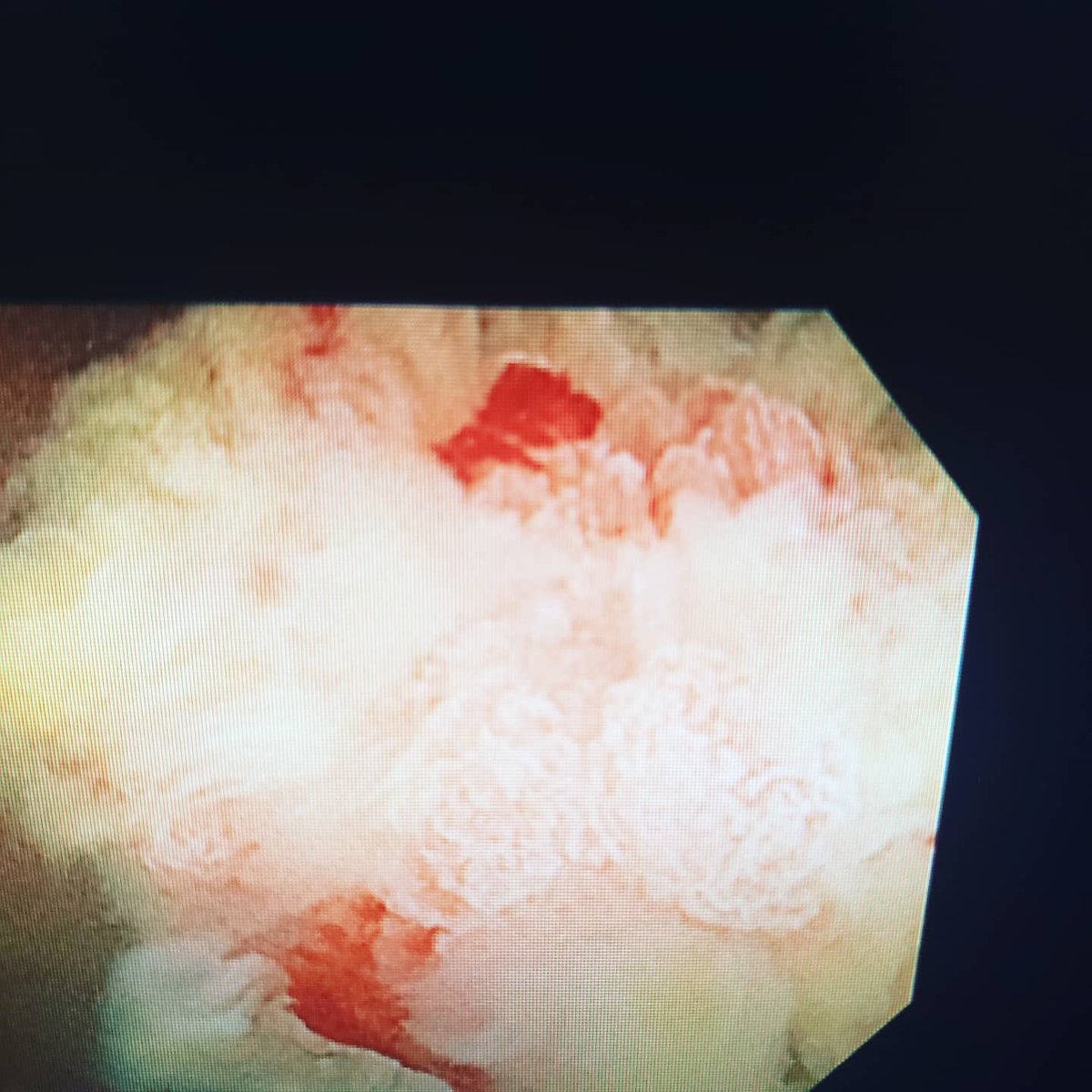 GIDrDon's tweet photo. #Polypthursday here are some more pictures of this odd looking polyp. What do you think? #GITwitter? @GI_Pearls @sqabbasi @MendozaLadd @PerelmansPearls @SanchezLunaMD @RodriguezParra_ @BilalMohammadMD @AllonKahn @DCharabaty @AhmadBazarbashi @drkeithsiau @ChahalPrabhleen https://t.co/MB7mh97Z4b