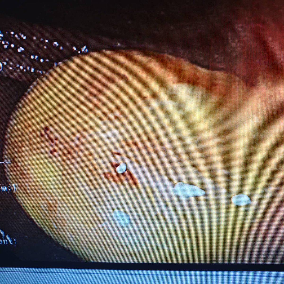 GIDrDon's tweet photo. #Polypthursday here are some more pictures of this odd looking polyp. What do you think? #GITwitter? @GI_Pearls @sqabbasi @MendozaLadd @PerelmansPearls @SanchezLunaMD @RodriguezParra_ @BilalMohammadMD @AllonKahn @DCharabaty @AhmadBazarbashi @drkeithsiau @ChahalPrabhleen https://t.co/MB7mh97Z4b