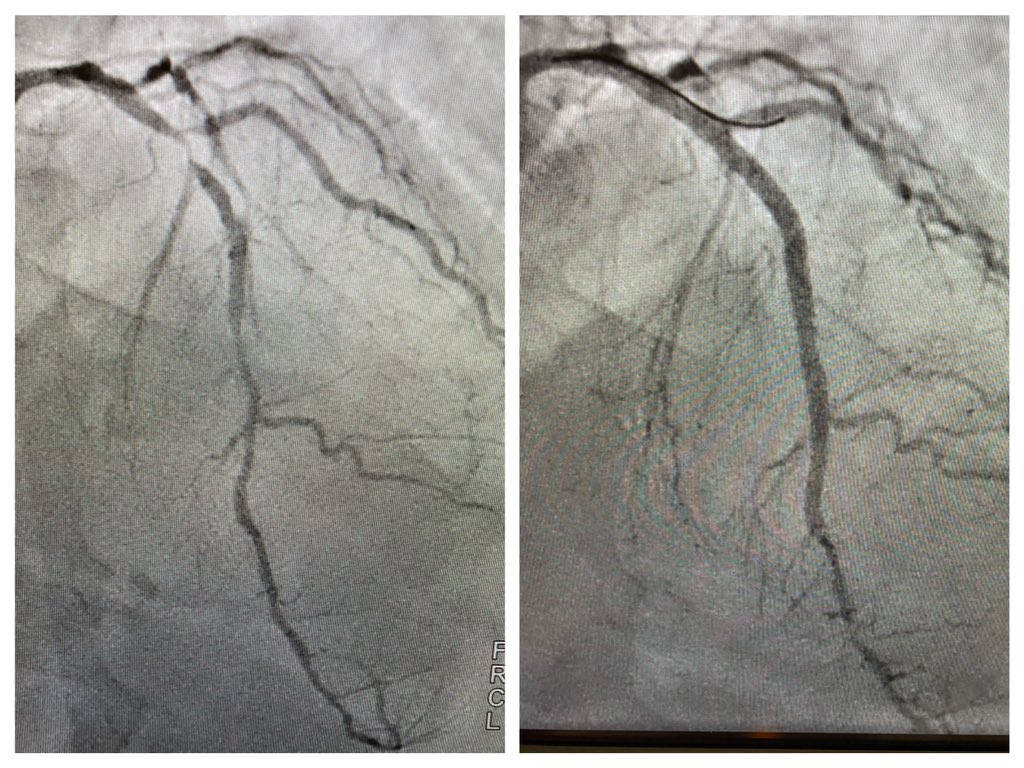 DK crush for LAD/Diag bifurcation 👍🏻
#RadialFirst #pcicase