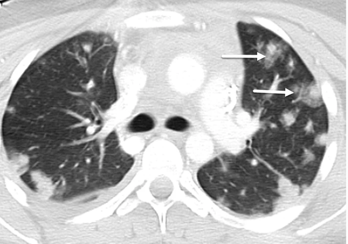 PedRadJournal's tweet photo. Prevent understaging/delay in diagnosis for metastatic disease in children with this pictorial review of atypical pulmonary metastases in children. Online now: Pediatric Radiology. CME activity.
#CT #pedrad #radiology #halosign #pulmonary #Pediatrics
https://t.co/VIyOk4bjCM https://t.co/A6NZbFuWXf