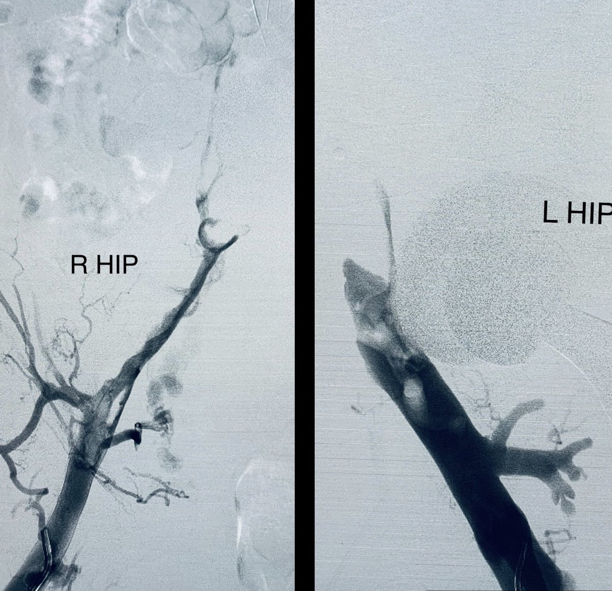 t_intheleadcoat's tweet photo. ☝🏾 more to epidemic, #IVCfilter related Iliocaval subacute thrombosis.
SAH & subdural (2 months)
#singlesessionthrombectomy
#NOTPA #NOICU
RIJ Tunneling, B/L frog leg
Flouro-20 mins EBL- 100ml
Thx to Dr. Whitney for helping hand
@SIRRFS @InariMedical @CAIRweb @ISVIRIndia https://t.co/nYS7V1H6aw