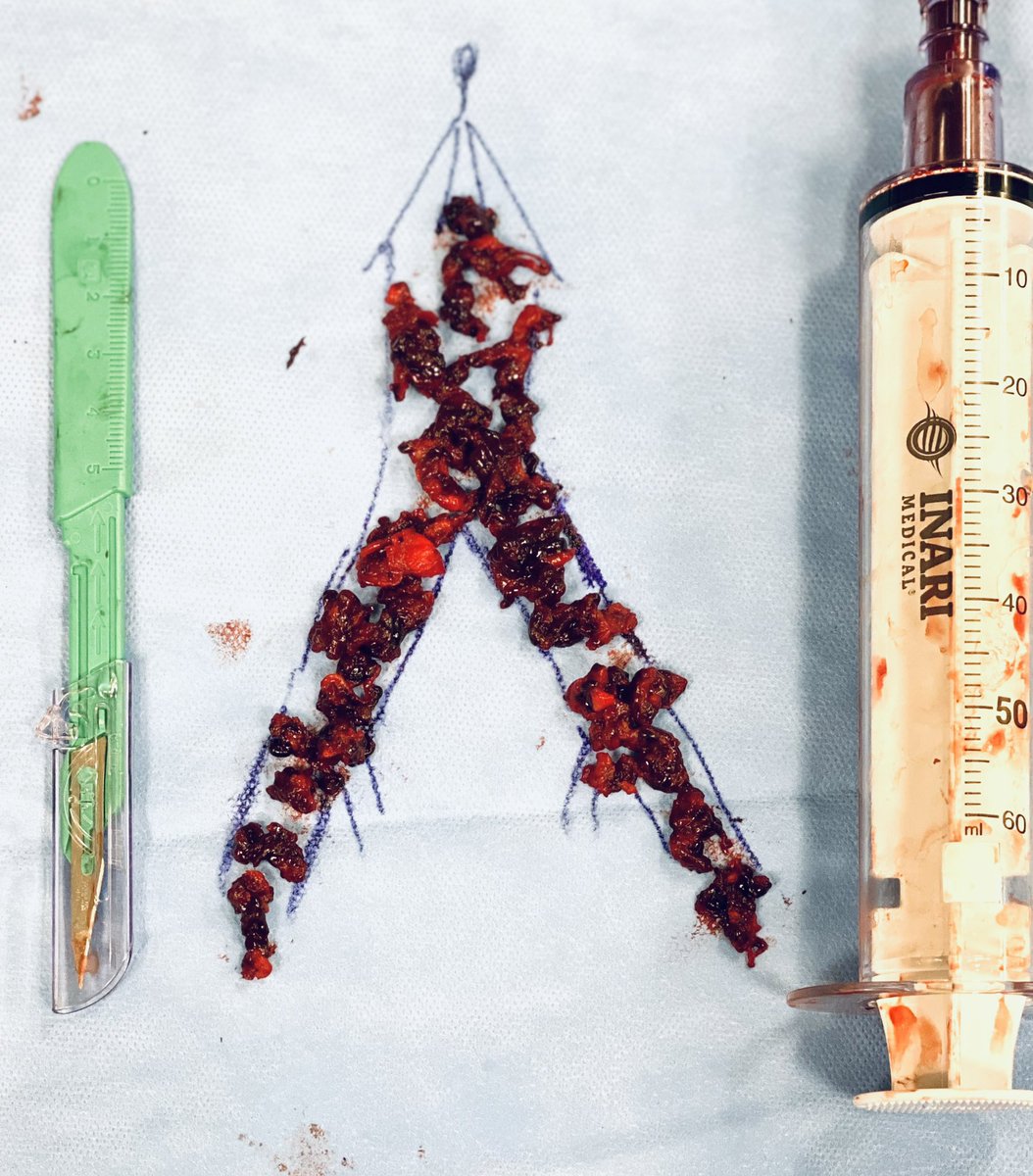 t_intheleadcoat's tweet photo. ☝🏾 more to epidemic, #IVCfilter related Iliocaval subacute thrombosis.
SAH & subdural (2 months)
#singlesessionthrombectomy
#NOTPA #NOICU
RIJ Tunneling, B/L frog leg
Flouro-20 mins EBL- 100ml
Thx to Dr. Whitney for helping hand
@SIRRFS @InariMedical @CAIRweb @ISVIRIndia https://t.co/nYS7V1H6aw