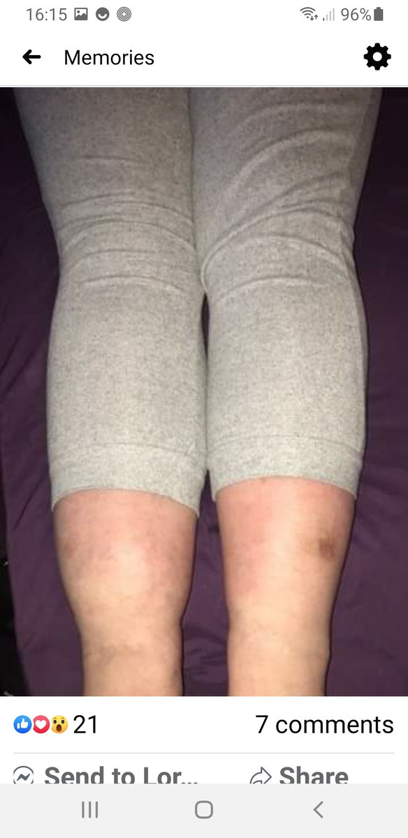Sootheursole's tweet photo. I just ❤the effects that Reflexology Lymphatic Drainage has for my lovely clients.This post came up on my memories #sootheursole #lymphaticdrainage #reflexology #lymphoedema #edema #health #wellbeing #pmt #fibromyalgia #arthritis #asthma #chronicfatigue #Headaches #muscularpain https://t.co/HyzZKBeAzr