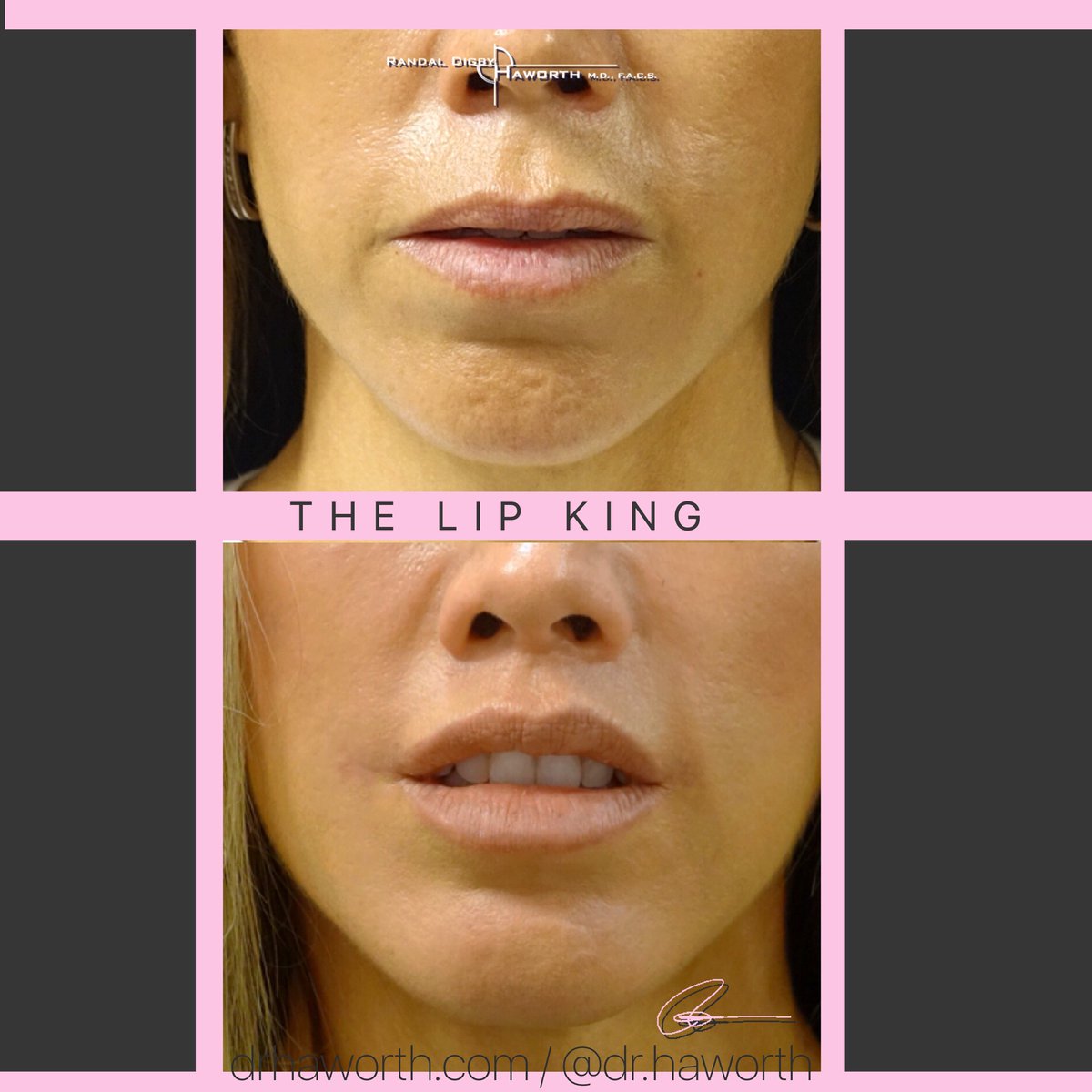 She needs reshaping- not volume -because she has all the volume she needs😱So reshaping she got-my OOS UPPER LIP LIFT 💋, MEDIALIZED corner lip lift🔝 and lower lip V2Y⬇️.  #DrHaworth 

🌐DrHaworth.com