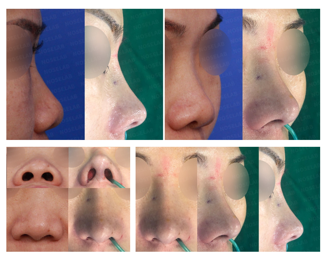 Dr Kang Noselab Plasticsurgery No Twitter Small Nose Correcting Short Nose Bulbous Nose Columella Lengthening Closed Rhinoplasty 小鼻 矯正 小鼻 球根鼻 閉鼻形成術 小鼻子 矫正短鼻子 球状鼻 结肠炎加长鼻腔 闭合鼻整形术 T Co Up0qvw37fg