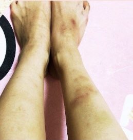 19. Behind every one of her amazing pole dance performances there is quite a lot of hardship to be endured, there was swelling and bruises everywhere around solar’s knees and ankles after practice.