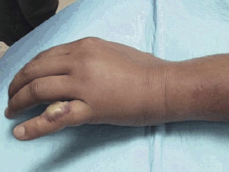 Indiana University Infectious Diseases Fellowship tweet media