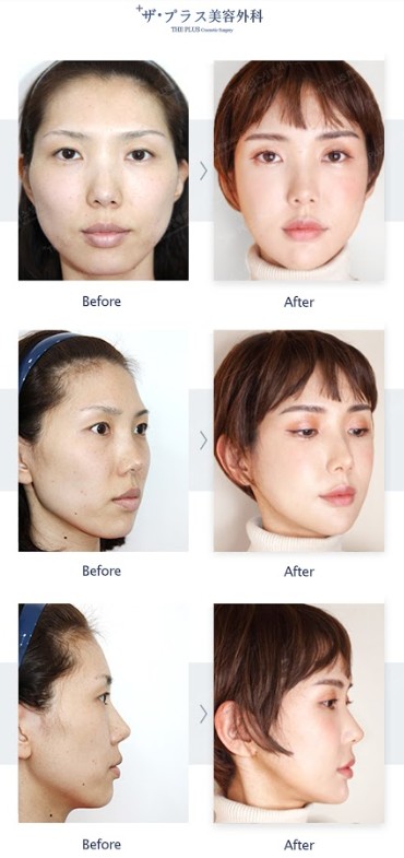 ザ プラス美容外科ソウル The Plus Plastic Surgery Seoul 輪郭3点 頬骨縮小 エラと顎削り フルフェイス脂肪移植 韓国美容整形 韓国輪郭手術 韓国整形 頬骨縮小 エラ削り 顎削り 脂肪移植 顎先縮小 Vライン Translate Tweet