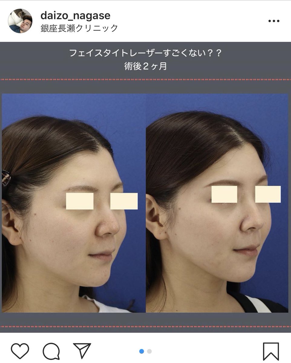 Dr すみれーしょん Dr레이숀 まじでフェイスタイトもっと人気出ていいと思うけどな Rf推し気味のわたしとしては効果見ててもすごいしフェイスタイトは内側と外側からrf加えるから皮膚のたるみにはまじで効いてる気がするけどなー脂肪吸引と一緒にやると