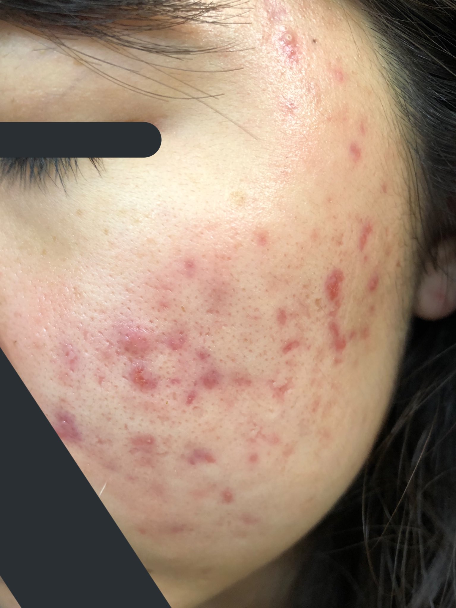 肌荒れなおす On Twitter 8 16 10 16 薬飲み始めてから3ヶ月経ちました 飲み始めたときの写真がなかったから2ヶ月前の写真だけど 2ヶ月すぎたあたりから少しずつ効果を感じてきて 最近やっと化粧である程度隠せるくらいになった 特に左頬のニキビとニキビ跡が