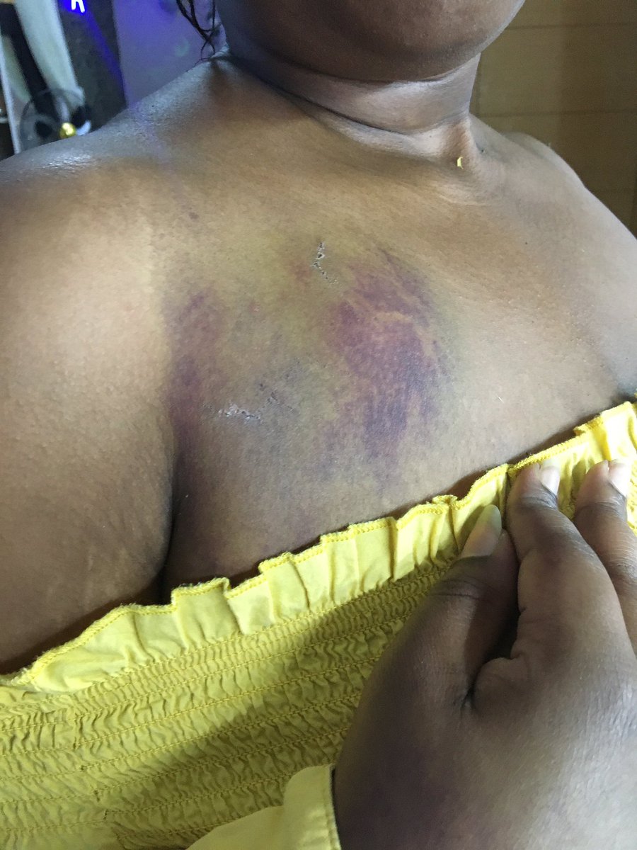 Hey everyone. This is what the Nigerian police force did to me for peacefully protesting in Abuja this past Sunday. We need to let the world know that protesters are being brutalized and killed for protesting against being brutalized and killed. Read the thread  #EndSARS    #EndSWAT