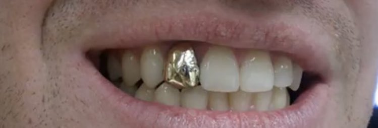 Металлическая коронка на зуб. Где сейчас зубы. Где сейчас зубы. Где сейчас зубы. Зубы джонни деппа.