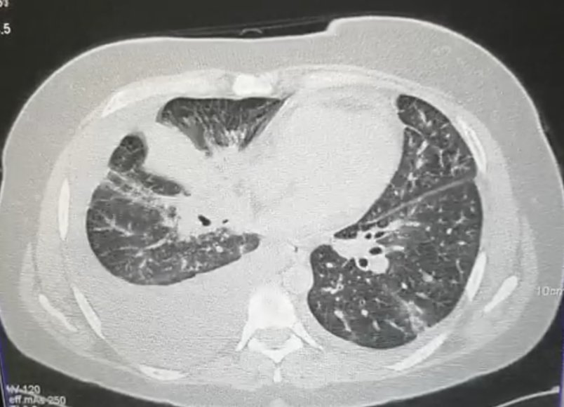 SebastianRLL's tweet photo. A 42 year old female patient with a 2 month progressive cough and dyspnea that began after a COVID19 mild disease. Additional symptoms include occasional hemoptoic phlegm (the last one, 1 week ago), hair-loss and a 7kg weight loss. No relevant previous history. Non-smoker. https://t.co/RyoBYB3QtH