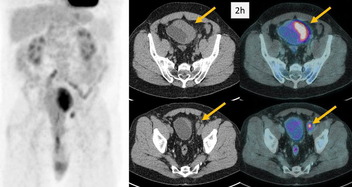 57yo Male. PET/CT Staging bladder high grade NET. Delayed acquisition after diuretic better depicting the primary tu and pelvic LN uptake.

➡️Background effect messing our interpretation of the primary tumor. 
❓Do you think delayed images are useful?