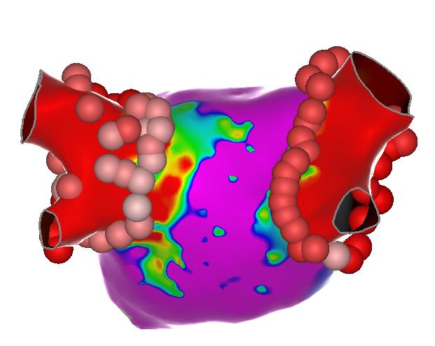 JayDoshiEP's tweet photo. Once again, another successful case with the use of VISITAG SURPOINT module or otherwise known as the Ablation Index. Solid set of lesions with 3 mm size tags and a single number (AI) to target. #Consistency #BiosenseWebster #CARTO #PVI #SURPOINT

@ZeeshanNYC 
@BiosenseWebster https://t.co/2DvYVauT7M