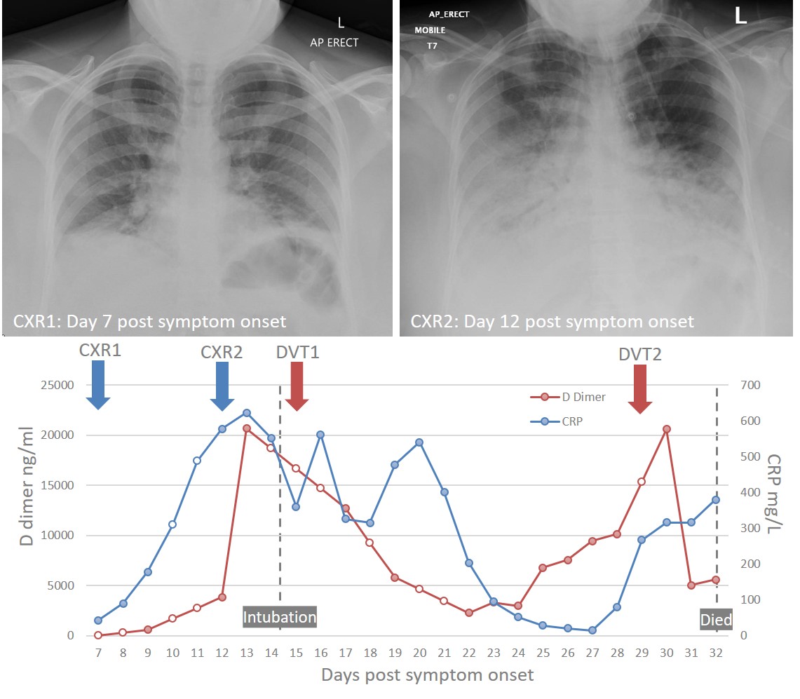 Our review on Emerging Immuno-Thrombotic Therapies for #COVID19 is now out in <a href="/BritJClinPharm/">British Journal of Clinical Pharmacology (BJCP)</a>
Includes this clinical case illustrating the link between hyperinflammation and coagulation. MelanieJensen <a href="/DerekGilroy1/">Derek Gilroy</a> @ReechaSofat
dx.doi.org/10.1111/bcp.14…