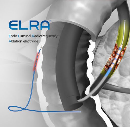 GiorgiaAla's tweet photo. Well done to Mayur Kumar and his PRUH crew on their very first #Endobiliary #RFA procedure! 👏🏼
Joint endo &amp; IR approach.
2 #ELRA probes used for in-stent ablations.
All supported remotely by yours truly via WhatsApp video! 🙋🏽‍♀️
Pandemic, we fear you not! 😷🤳🏽

⁦@AquilantGI⁩ https://t.co/BnO2Fm3Tm1