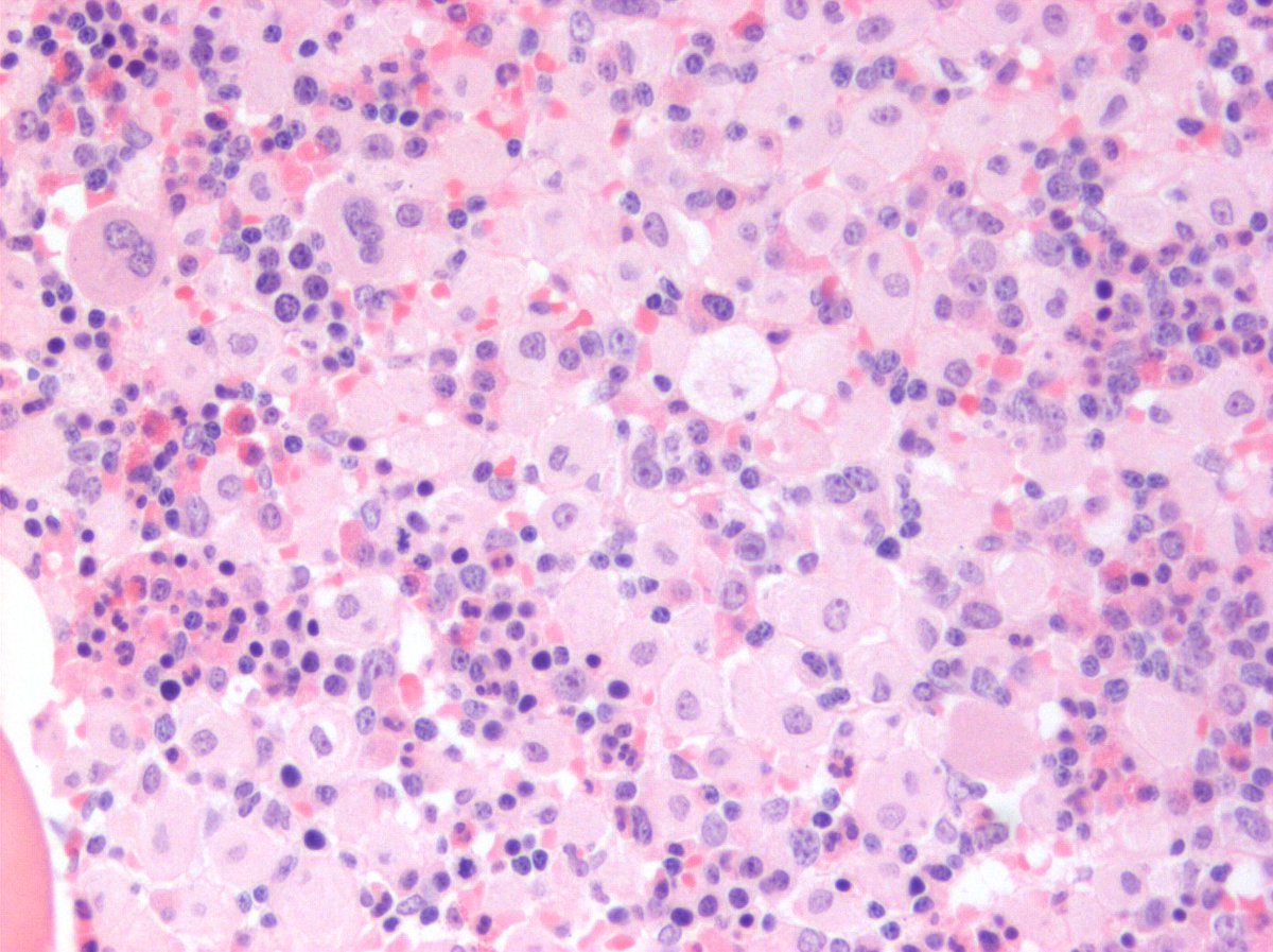 DennisOMalleyMD's tweet photo. #hemepath Gaucher dz in bone marrow https://t.co/6nXxbswvwq