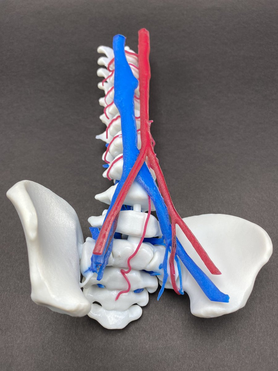 JayMorris_MD's tweet photo. Neurovascular malformations of the spine in #pediatrics have many presentations #AVM #DuralAVF & #Perimedullary #AVF. You really have 1 maybe 2 chances to get treatment right. #3Dprinting life size models @MayoRadiology @MayoClinicKids allows greater understanding of anatomy https://t.co/7hMhWNPluk