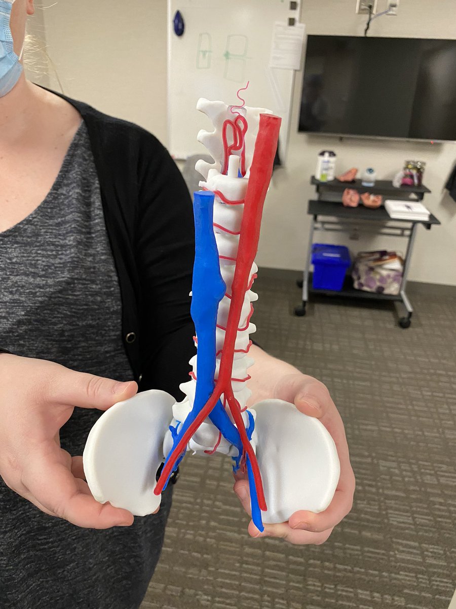 Jay Morris (@jaymorris_md) on Twitter photo Neurovascular malformations of the spine in #pediatrics have many presentations #AVM #DuralAVF & #Perimedullary #AVF. You really have 1 maybe 2 chances to get treatment right. #3Dprinting life size models <a href="/MayoRadiology/">Mayo Clinic Radiology</a> <a href="/MayoClinicKids/">Mayo Clinic Children's</a> allows greater understanding of anatomy Neurovascular malformations of the spine in #pediatrics have many presentations #AVM #DuralAVF & #Perimedullary #AVF. You really have 1 maybe 2 chances to get treatment right. #3Dprinting life size models <a href="/MayoRadiology/">Mayo Clinic Radiology</a> <a href="/MayoClinicKids/">Mayo Clinic Children's</a> allows greater understanding of anatomy