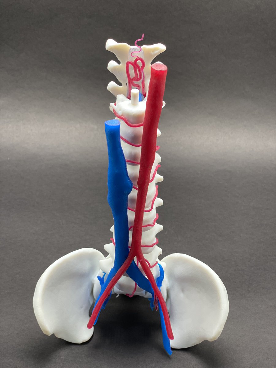 JayMorris_MD's tweet photo. Neurovascular malformations of the spine in #pediatrics have many presentations #AVM #DuralAVF & #Perimedullary #AVF. You really have 1 maybe 2 chances to get treatment right. #3Dprinting life size models @MayoRadiology @MayoClinicKids allows greater understanding of anatomy https://t.co/7hMhWNPluk