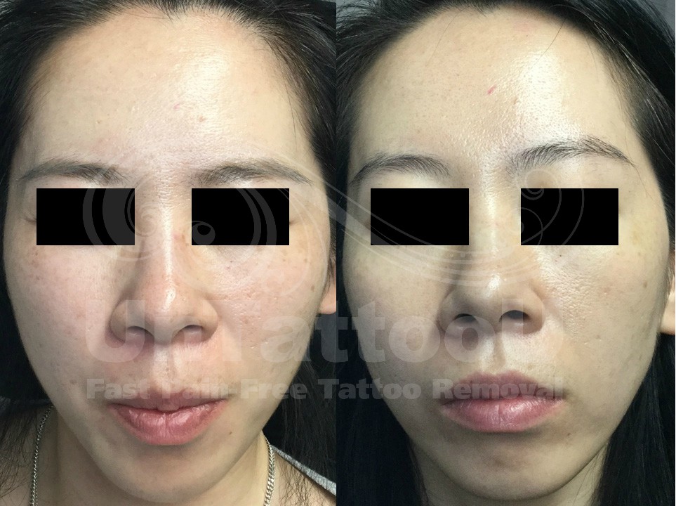 UntattooU's tweet photo. Feel Confident with a Clear Complexion
Rest assured with the precise and powerful results of #Picosure Focus.
PicoSure Focus #LaserTreatments uniquely stimulate your natural skin refreshing processes to create brighter, younger-looking skin - with virtually no downtime. https://t.co/XhrAKrk81O