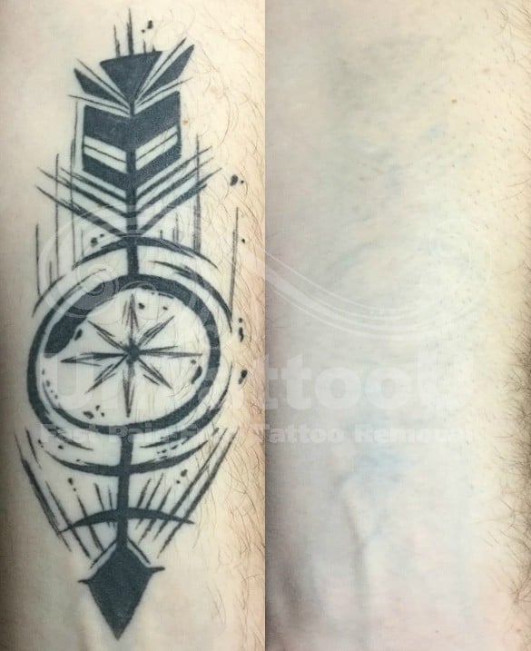 UntattooU's tweet photo. BEFORE &amp; AFTER
#PicoSure Laser Tattoo Removal

https://t.co/VHIVh69CUK
703.255.2600

#lasertattooremoval #tattooremoval #tattooremovalexperts #cynosure #UnTattooU https://t.co/jbjl46bytv