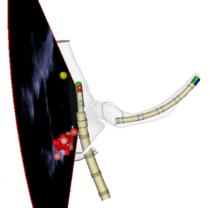 JayDoshiEP's tweet photo. ZERO Fluoro Typical Flutter Ablation with the help of ICE, VIZIGO, DECANAV and the STSF

#EPeeps 

@ZeeshanNYC 
@BiosenseWebster https://t.co/aKixDa4rOj