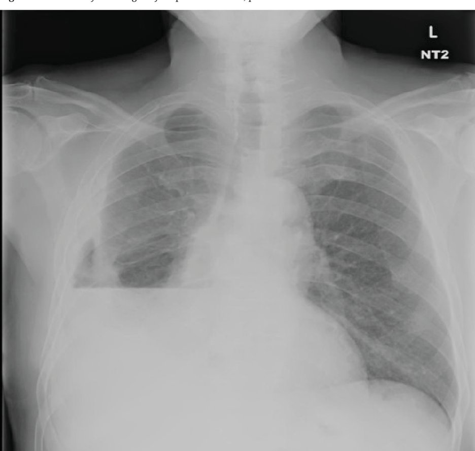 1/ Have you ever heard your friendly pulmonologist use the terms “entrapped” or “trapped” lung and were confused about the terminology? If so you are not alone and this is the tweetorial for you!  #MedTwitter  #tweetorial  @crit_caring_MD  @lkbrath  @VCU_PCCM  @PSinkam