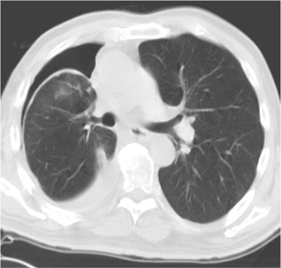 1/ Have you ever heard your friendly pulmonologist use the terms “entrapped” or “trapped” lung and were confused about the terminology? If so you are not alone and this is the tweetorial for you!  #MedTwitter  #tweetorial  @crit_caring_MD  @lkbrath  @VCU_PCCM  @PSinkam