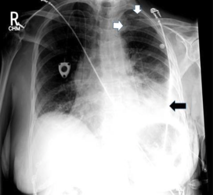 4/Lung entrapment is when the lung cannot fully expand due to an active disease that restricts the expansion of the lung and/or visceral pleura. This is typically associated with an exudative effusion.  @tony_breu  @KevinSwiatek
