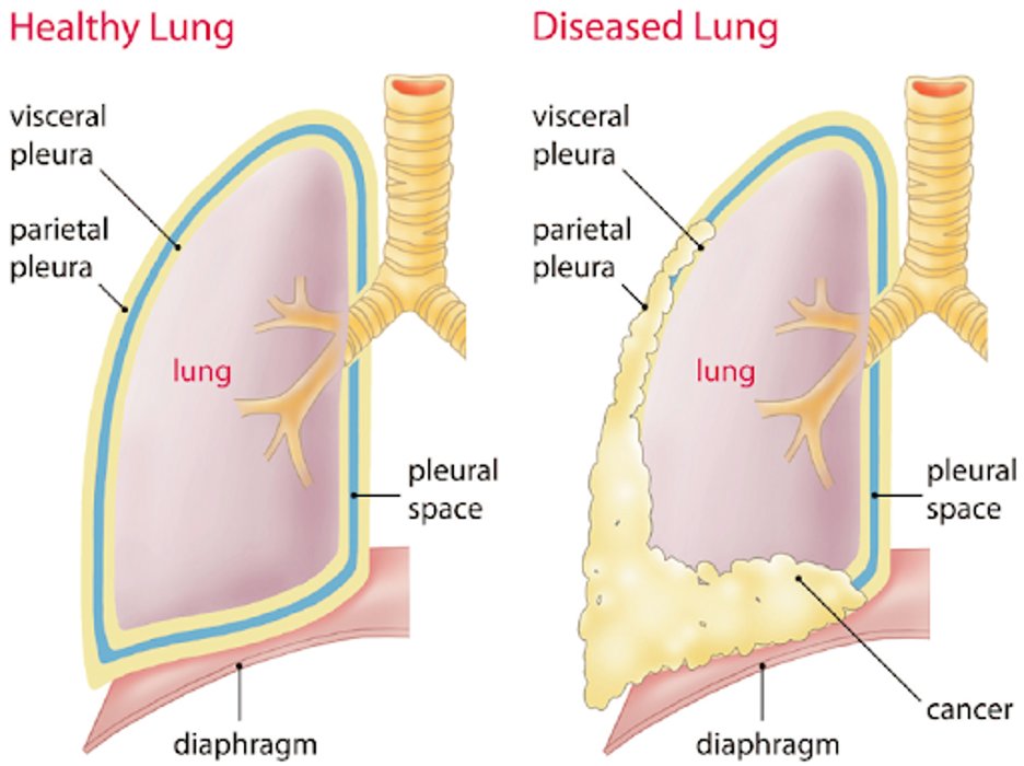 6/Let’s dive into lung entrapment. The most common cause of lung entrapment is due to pleural malignancy with an estimated 30% of malignant effusions leading to lung entrapment. However, pleural infections or inflammation can also lead to lung entrapment.