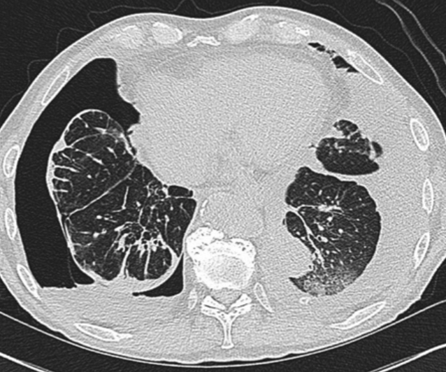 12/In trapped lung, the fibrotic process affecting the visceral pleura causes an increase in the negative pleural pressure resulting in fluid accumulation and reduction in the removal of fluid by pleural lymphatics.  @UpToDate  @gsmartinmd  @jackpenner