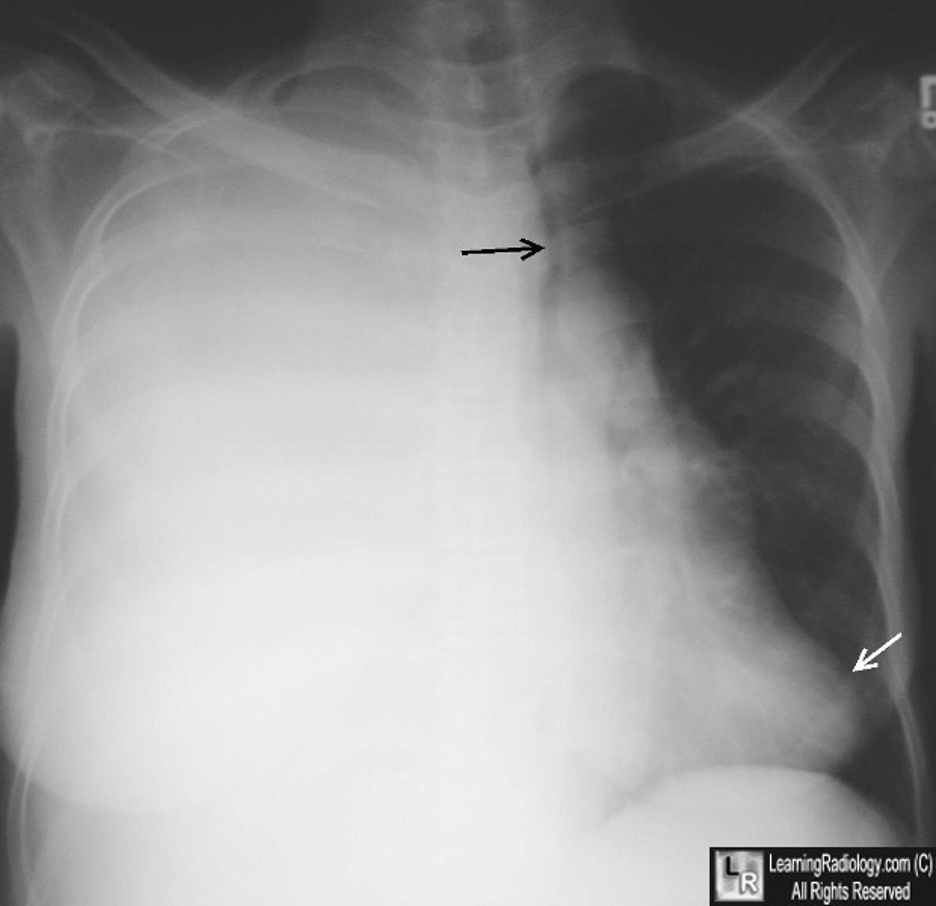 10/ With large pleural effusions, you typically get a contralateral shift of the mediastinum. However, with lung entrapment you will typically see the mediastinum shift ipsilaterally of the effusion or no shift at all.  @CritCareMed  @PulmCrit  @MedEdPGH  @gradydoctor