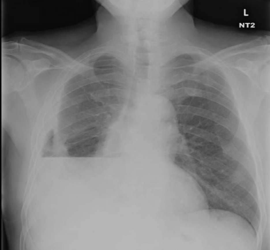 10/ With large pleural effusions, you typically get a contralateral shift of the mediastinum. However, with lung entrapment you will typically see the mediastinum shift ipsilaterally of the effusion or no shift at all.  @CritCareMed  @PulmCrit  @MedEdPGH  @gradydoctor