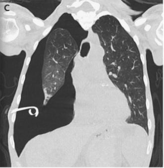 14/Imaging of trapped lung will typically show pleural thickening and loculation. An air contrasted CT can be used to better visualize the visceral pleura rind or you can use direct visualization with video-assisted thoracoscopy.  @ReenaHem  @ERitterMD  @VCURadRes  @MarkZieglerMD