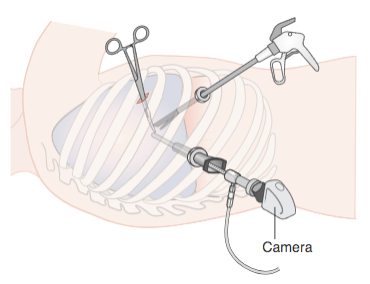 16/ Management of an asymptomatic trapped lung is NOT pleural drainage as the effusion will just re-accumulate. However, decortication of the visceral pleura rind with VATS is typically your treatment for symptomatic patients who are surgical candidates.  @VCUIMClerkship