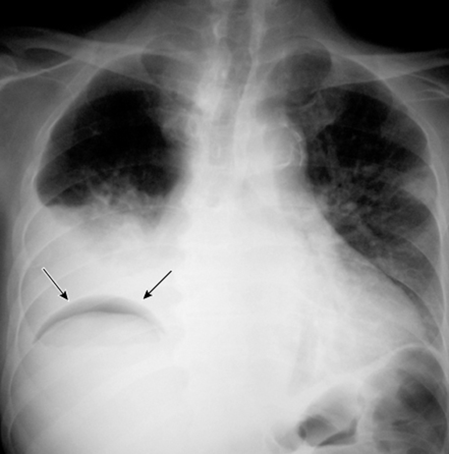 17/ Trapped lung and lung entrapment should not be confused with pneumothorax ex vacuo, which is an acute bronchial obstruction that leads to lobar collapse with a marked increase in negative pleural pressure. Treatment is removal of the obstruction and NOT a chest tube.