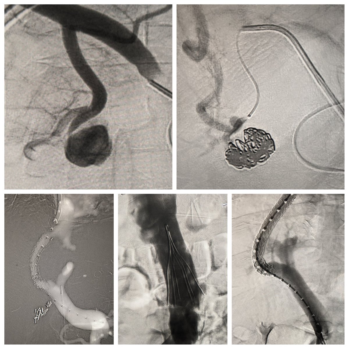 Justin Greene (@greenerads) on Twitter photo Great week back on IR! Highlights including 2 TIPS, solo IVC filter, and necrotizing pancreatitis GDA pseudoaneurysm embolization. <a href="/ManuSinghMD/">Manu Singh</a> <a href="/SIRRFS/">SIR RFS</a> <a href="/SIRspecialists/">Society of Interventional Radiology</a> <a href="/USC_IR/">USC IR</a> <a href="/uclaVIR/">UCLA IR</a> <a href="/ColoradoIR/">Univ of Colorado IR</a> Great week back on IR! Highlights including 2 TIPS, solo IVC filter, and necrotizing pancreatitis GDA pseudoaneurysm embolization. <a href="/ManuSinghMD/">Manu Singh</a> <a href="/SIRRFS/">SIR RFS</a> <a href="/SIRspecialists/">Society of Interventional Radiology</a> <a href="/USC_IR/">USC IR</a> <a href="/uclaVIR/">UCLA IR</a> <a href="/ColoradoIR/">Univ of Colorado IR</a>